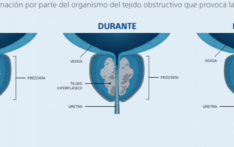 REZUM:  LA TERAPIA DE VAPOR DE AGUA PARA EL TRATAMIENTO DE LA PRÓSTATA AGRANDADA.